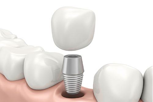Eat Better By Getting Dental Implants