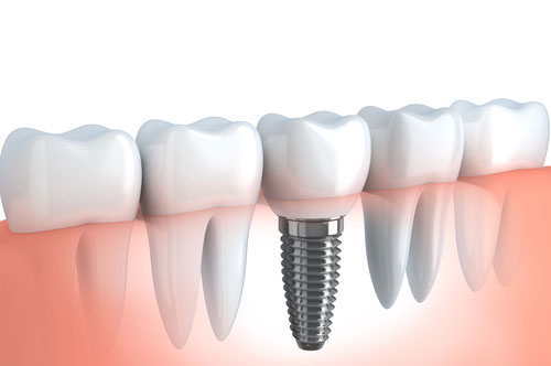 Hear Why Patients Prefer Dental Implants