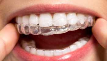 Find Answers About Invisalign & Straight Teeth